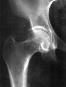 Before: The femur appears hollowed by bone cancer.